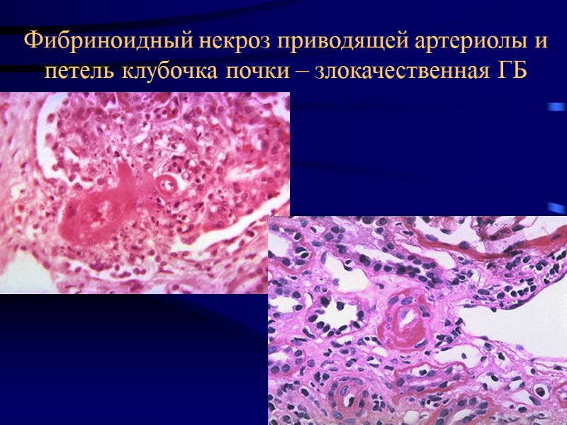 Фибриноидный некроз приводящей артериолы и петель клубочка почки – злокачественная ГБ